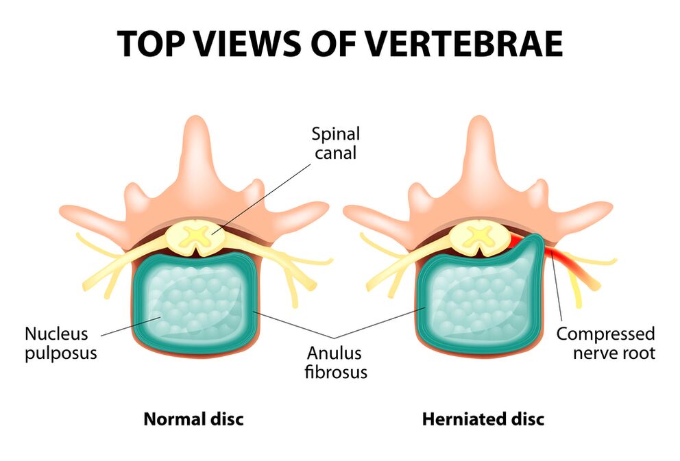 Disco intervertebral saludable y hernia