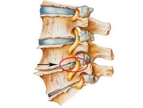 Los signos y síntomas de la osteocondrosis