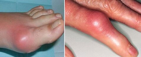 la aparición de articulaciones con artritis