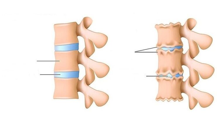 columna vertebral y columna sana afectada por osteocondrosis