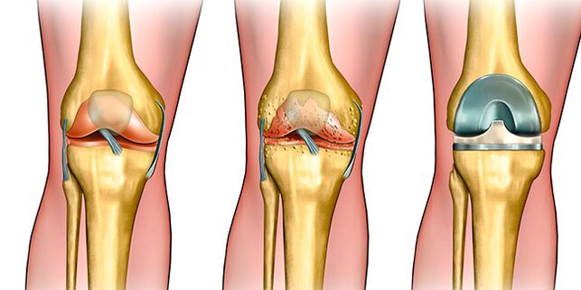 En la tercera etapa de la artrosis, se requiere reemplazo de rodilla.