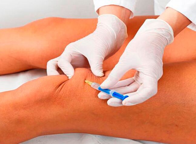 Inyección intraarticular de fármacos para la artrosis de la articulación de la rodilla.